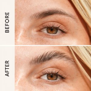 Brow lift Θεσσαλονίκη Brow lift Θεσσαλονίκη