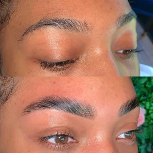 Brow lift Θεσσαλονίκη Brow lift Θεσσαλονίκη